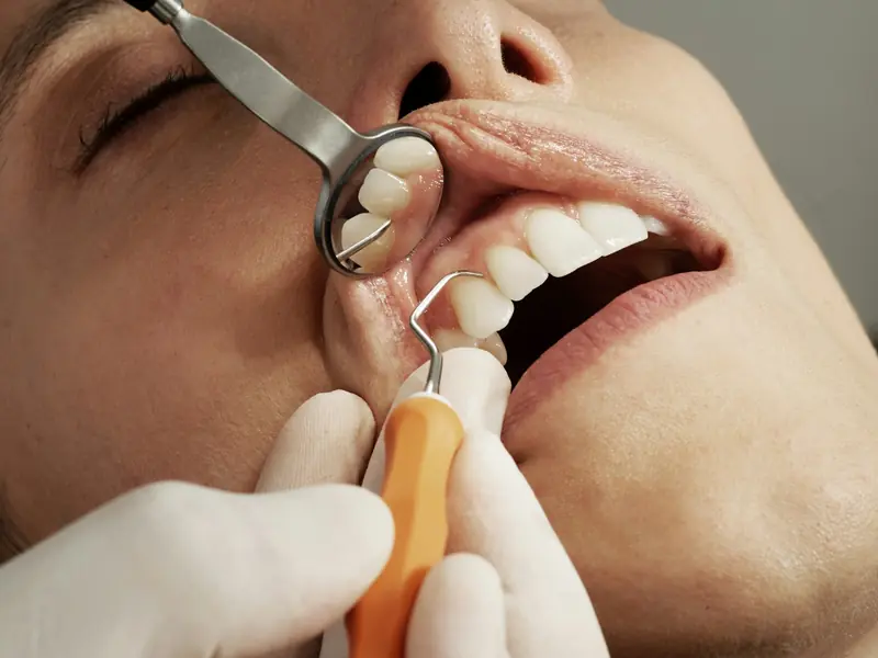 Examen des gencives au miroir et à la sonde parodontale