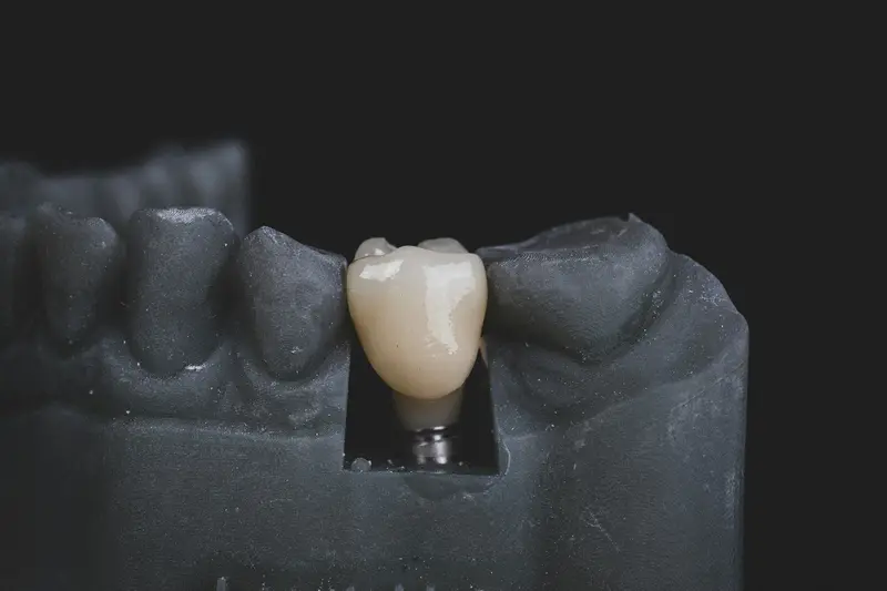 Prothèse complète fixée sur implants, sur modèle